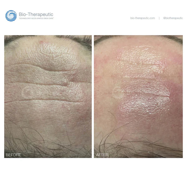 Bio-Brasion GEN4