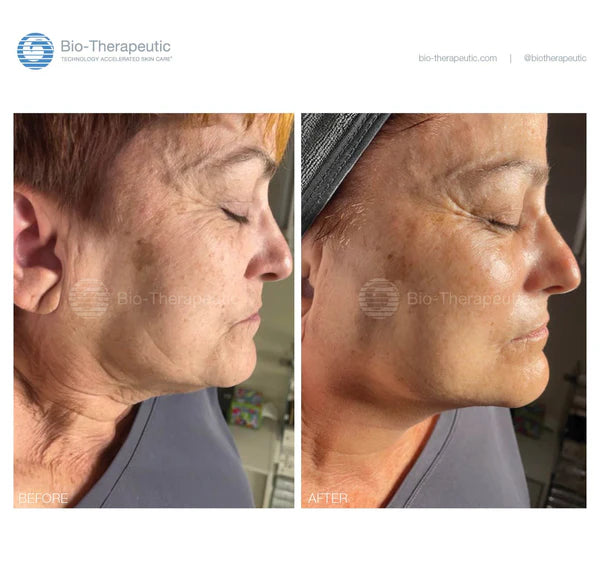 Bio-Brasion GEN4