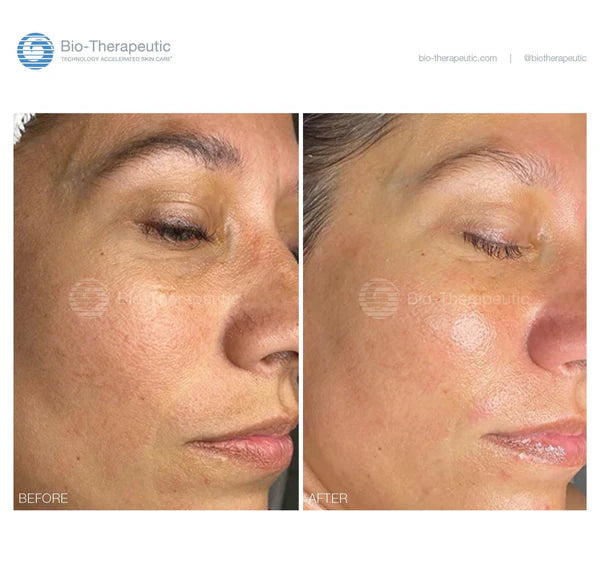 Bio-Brasion GEN4