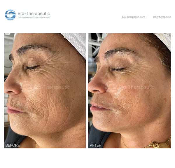 Bio-Brasion GEN4