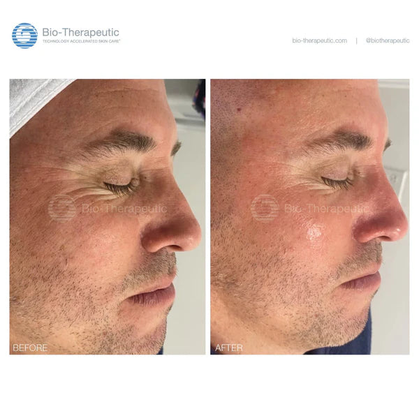 Bio-Brasion GEN4