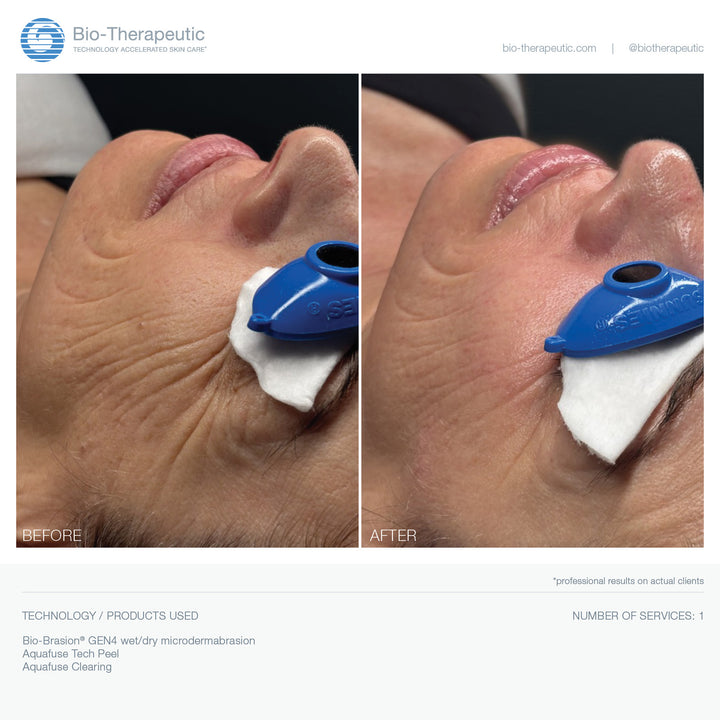 Bio-Brasion GEN4