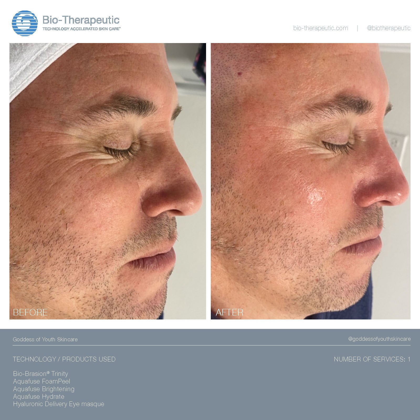 Bio-Brasion Trinity – Bio-Therapeutic