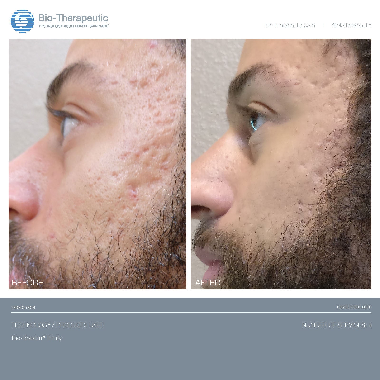 Bio-Brasion Trinity – Bio-Therapeutic Bio-Brasion Trinity – Bio-Therapeutic